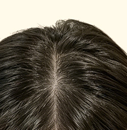 30-day follicle view