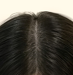 90-day follicle view