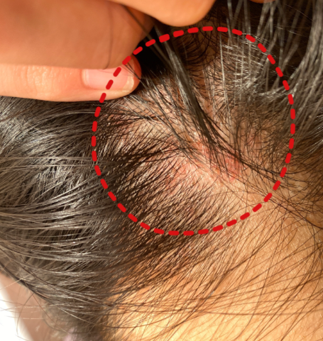 Got folliculitis bumps on your scalp? Never pick at them—this is the right way to treat them.