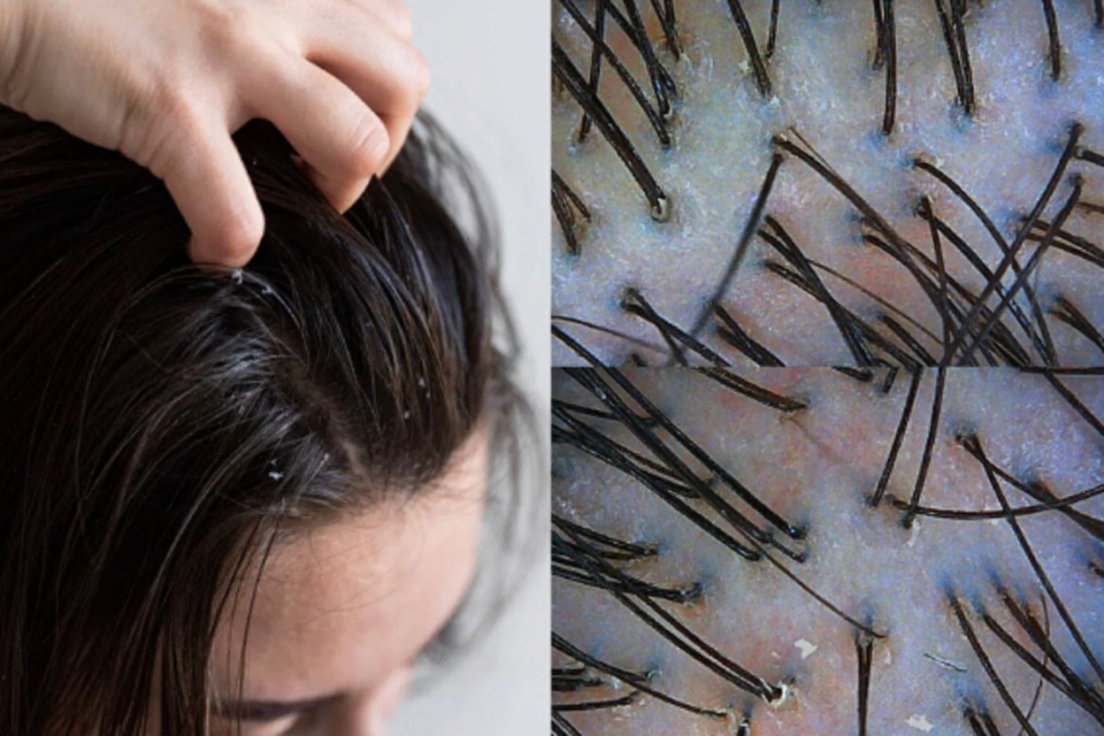 Oily scalp, dandruff, itchy scalp? Singapore scalp treatment brings the scalp environment back into balance