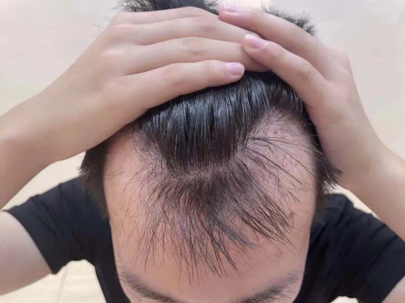 Severe hair loss and shedding? Singapore hair growth treatment awakens hair follicle growth power