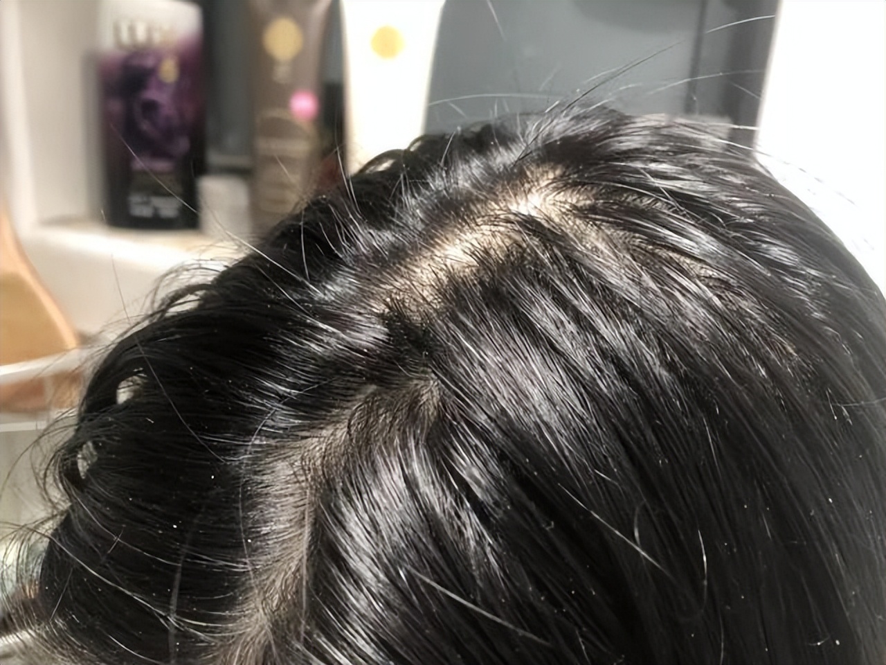 Why does hair get oily and have dandruff? Singapore scalp treatment repairs the scalp barrier