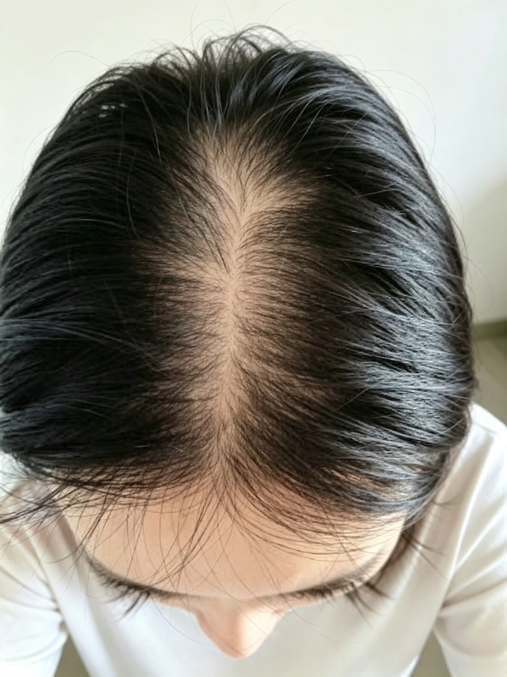 Thinning hair and a widening hair part—what to do? TSHL Hair Revitalising Therapy™ treatment helps you grow it back