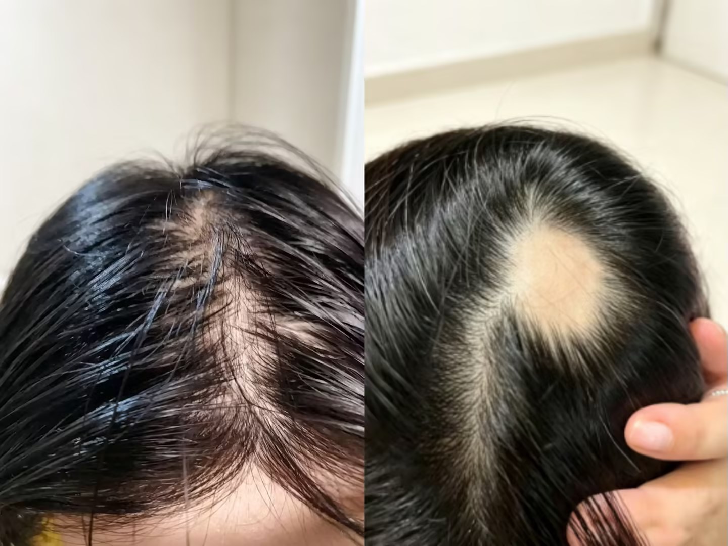 Severe hair loss, what should be done? Singapore hair growth treatment: examine first, then nourish the hair