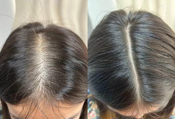 How to treat postpartum hair loss? Singapore Gongfangtang scalp care nourishes back a full crown