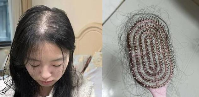 How to treat stress hair loss? Singapore GFT TSHL scalp care, nourish back from the hair follicles