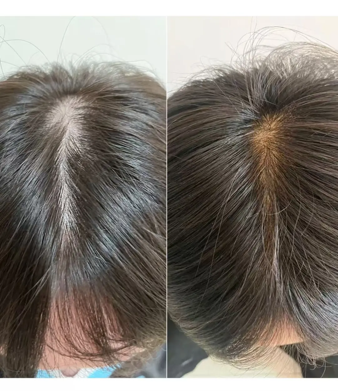 hair loss treatment Singapore——GFT TSHL Scalp Purifying Therapy: Purify the scalp environment and help your hair stand firm!