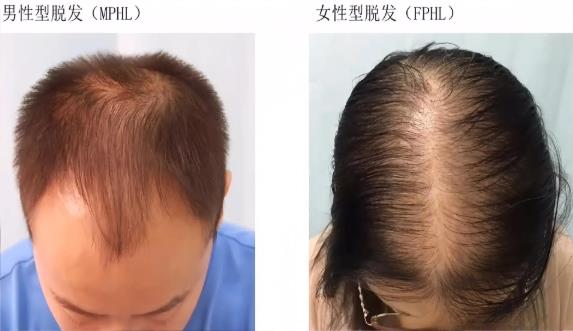 Hormonal hair loss in Singapore: how to treat it? GFT TSHL scalp care helps you regain thick, confident hair