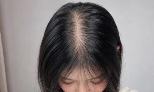 How to treat excessive hair fall? Singapore GFT TSHL therapy strengthens hair roots